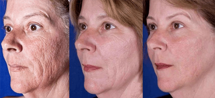 Result after a laser facial skin rejuvenation procedure