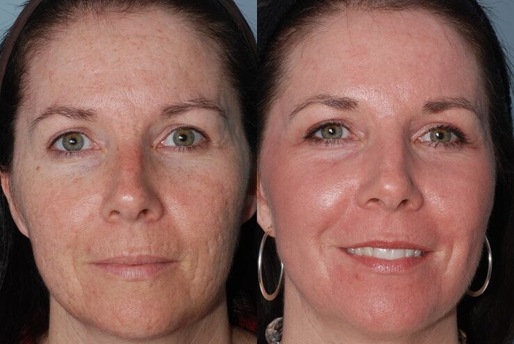 before and after skin rejuvenation of the material