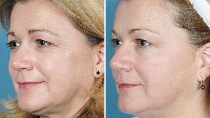 photos before and after skin rejuvenation of the material